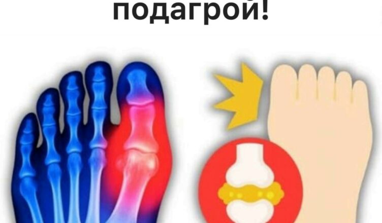 Топ-5 напитков, которые помогают снизить уровень мочевой кислоты и облегчить подагру.