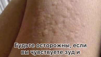 Почему на коже возникает крапивница? Неожиданные причины, о которых вы могли не догадываться.