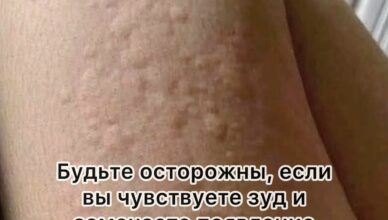 Почему на коже возникает крапивница? Неожиданные причины, о которых вы могли не догадываться.